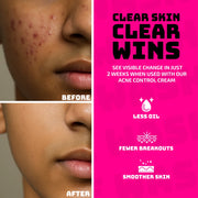 Anti-Acne Facewash for boys (120ml)